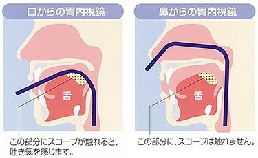 経鼻内視鏡の特徴