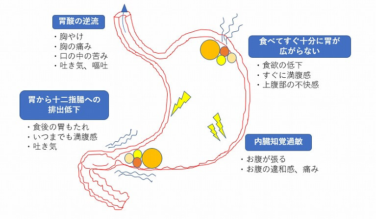 胃 の 張り 吐き気