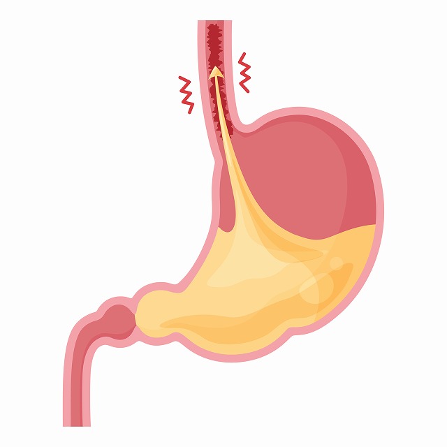 逆流性食道炎とは