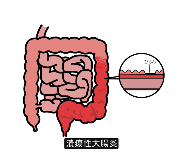 潰瘍性大腸炎
